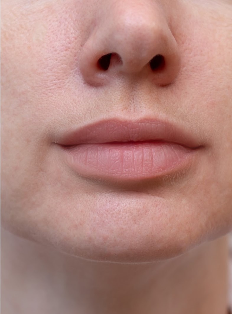 Lips B&A- after